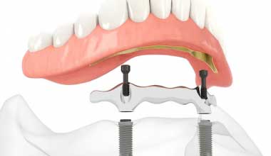 Mehr über Stegprothese