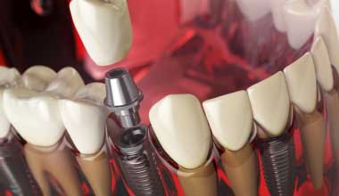 Mehr über Zahnimplantat