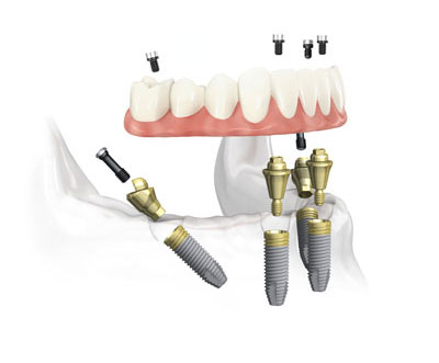 All-on-4® System Unterkiefer © Completdent