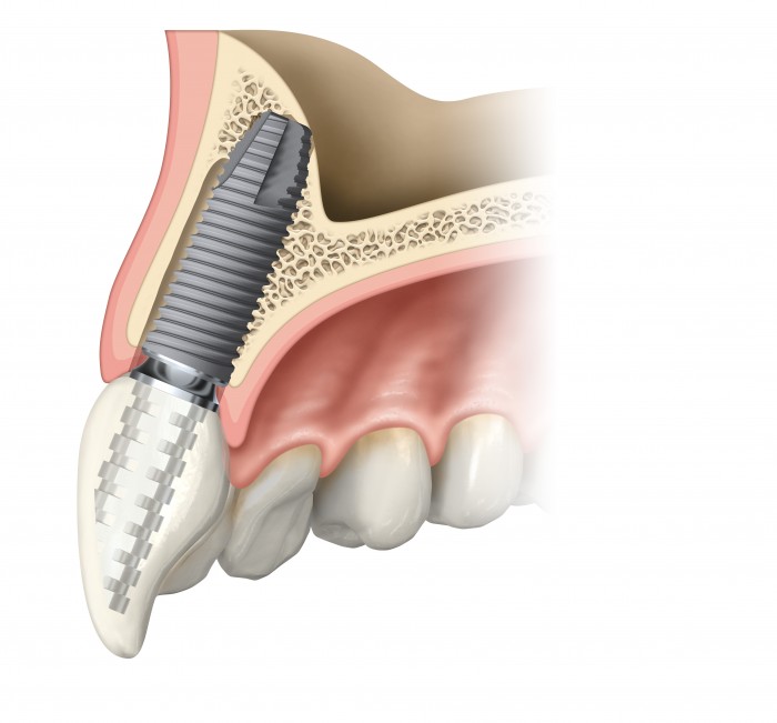 Frontalzahnimplantat Frontalzahnimplantat