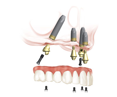 All-on-4® System Oberkiefer © Completdent