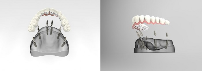 Stegprothese auf 6 Implantaten für maximale Belastung und Stabilität