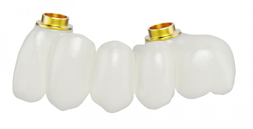 Implantatgetragene Zahnbrücke von Nobel Biocare Implantatgetragene Zahnbrücke von Nobel Biocare