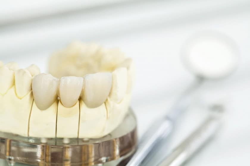 Keramische Zahnkronen Keramische Zahnkronen