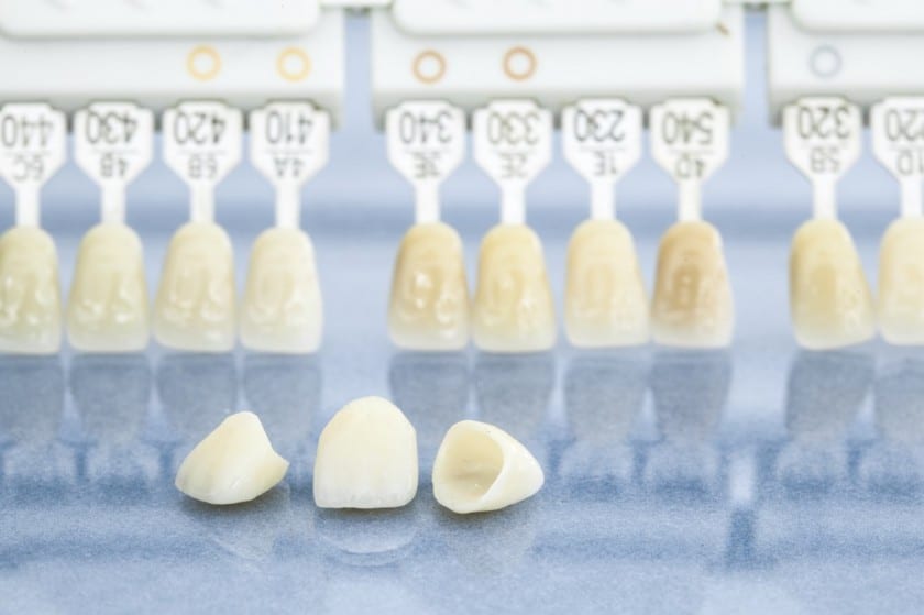 Zahnkronen im Frontzahnbereich sind in der Regel günstiger Zahnkronen im Frontzahnbereich sind in der Regel günstiger