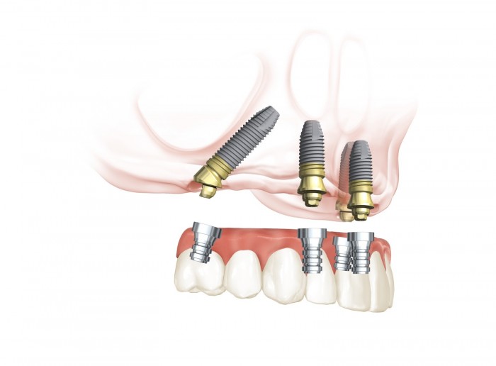 Stegprothese Modell © Completdent